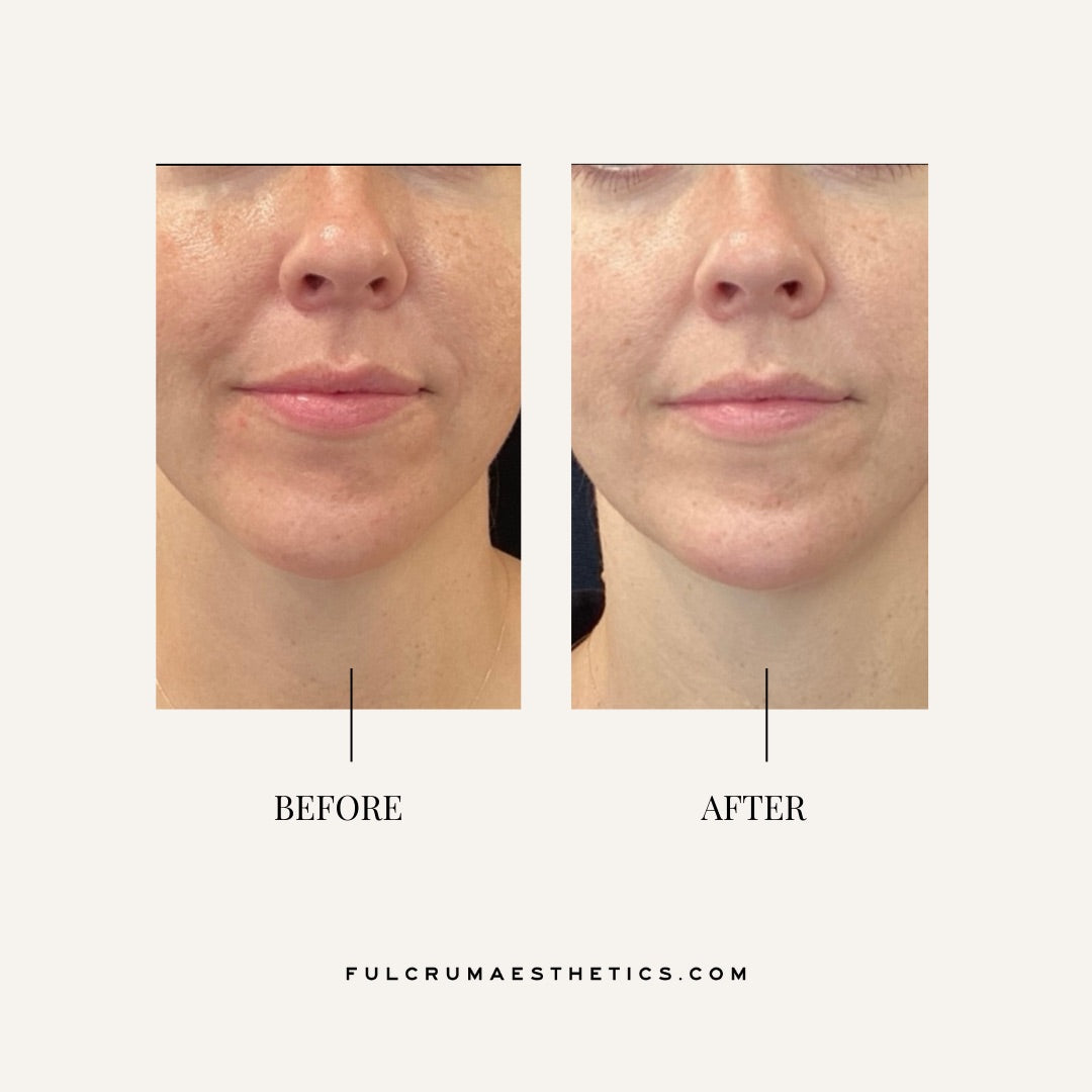 Photofacial (BBL/IPL)