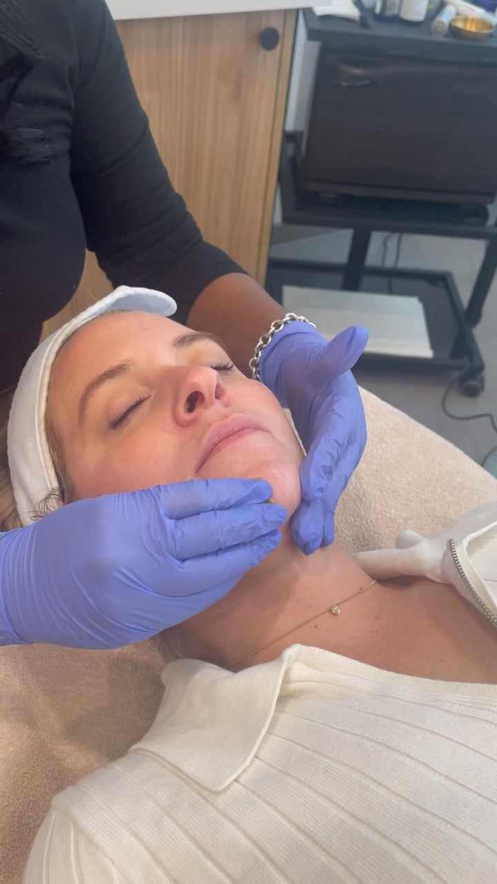 Chemical Peels