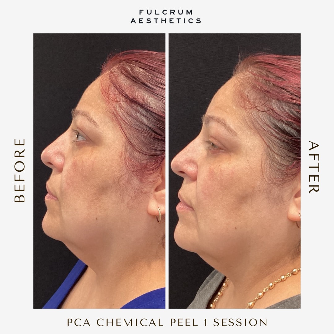 Chemical Peels