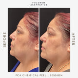 Chemical Peels