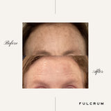 Photofacial (BBL/IPL)