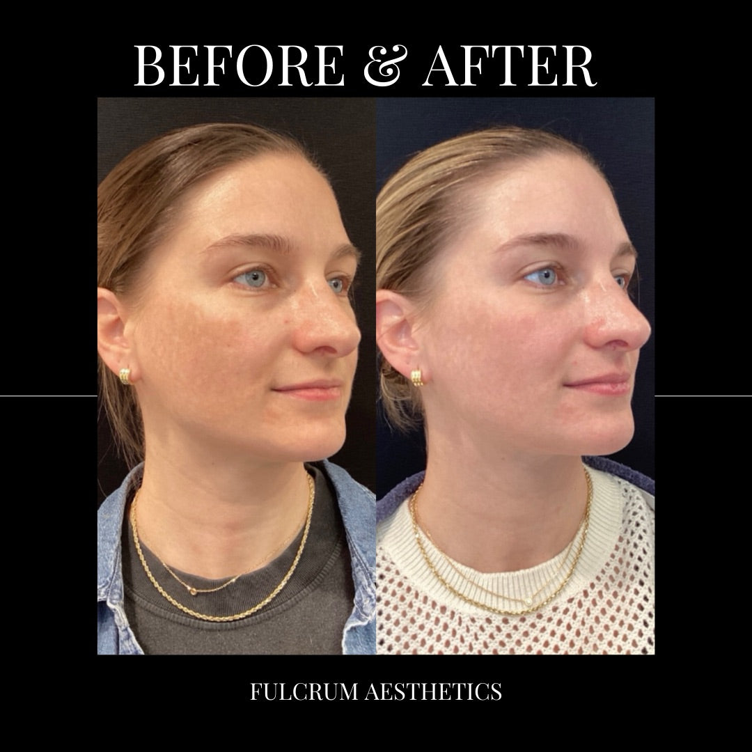1 treatment of MOXI