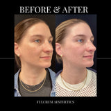 1 treatment of MOXI