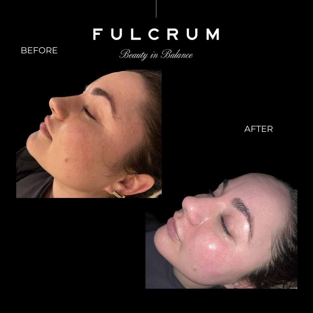 Chemical Peels
